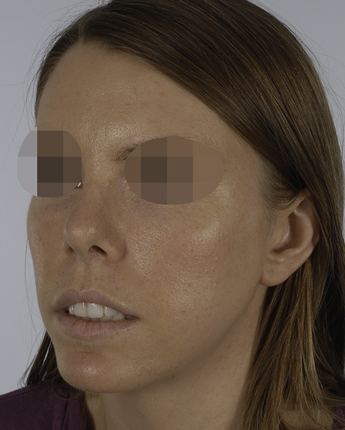 Asymmetry and Facial Reshaping Case 3220 After Photo Asymmetry and Facial Reshaping