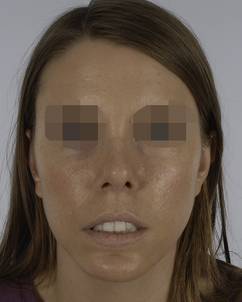Asymmetry and Facial Reshaping Case 3220 After Photo Asymmetry and Facial Reshaping