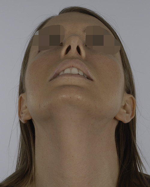 Asymmetry and Facial Reshaping
