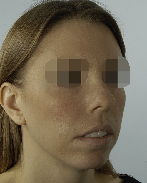 Asymmetry and Facial Reshaping Case 3220 Before Photo Asymmetry and Facial Reshaping