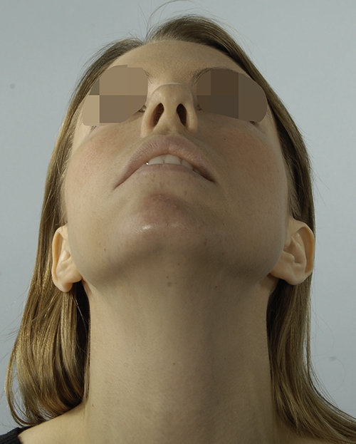 Asymmetry and Facial Reshaping Case 3220 Before Photo Asymmetry and Facial Reshaping
