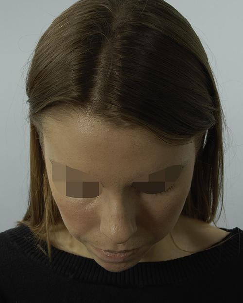 Asymmetry and Facial Reshaping Case 3220 Before Photo Asymmetry and Facial Reshaping