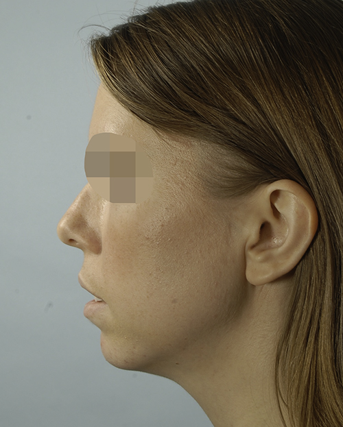 Asymmetry and Facial Reshaping Case 3220 Before Photo Asymmetry and Facial Reshaping
