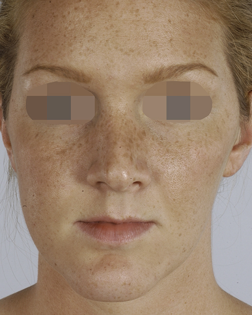 Asymmetry and Facial Reshaping Case 3221 Before Photo Asymmetry and Facial Reshaping