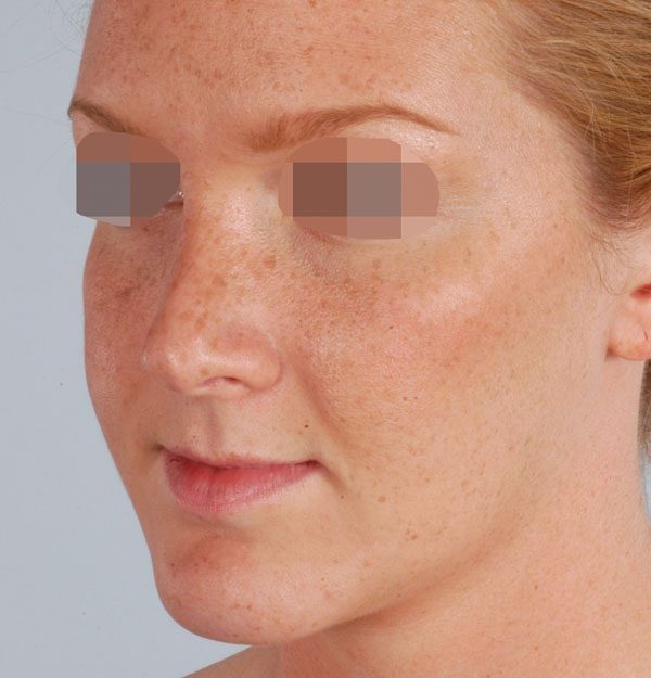 Asymmetry and Facial Reshaping Case 3221 Before Photo Asymmetry and Facial Reshaping