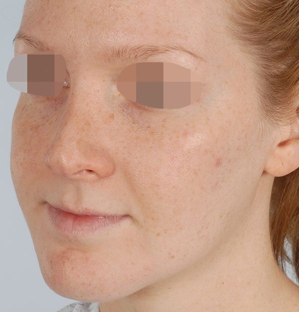 Asymmetry and Facial Reshaping Case 3221 After Photo Asymmetry and Facial Reshaping
