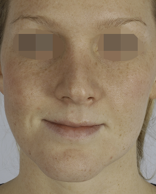 Asymmetry and Facial Reshaping Case 3221 After Photo Asymmetry and Facial Reshaping