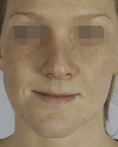 Asymmetry and Facial Reshaping