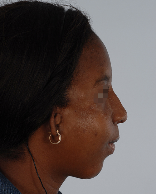 Craniofacial Cleft Case 3327 After Photo Craniofacial Cleft