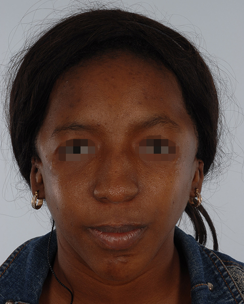 Craniofacial Cleft Case 3327 After Photo Craniofacial Cleft