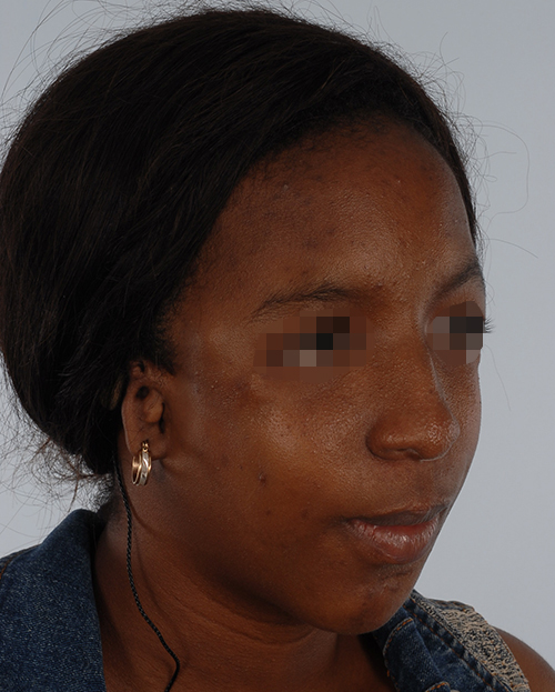 Craniofacial Cleft Case 3327 After Photo Craniofacial Cleft