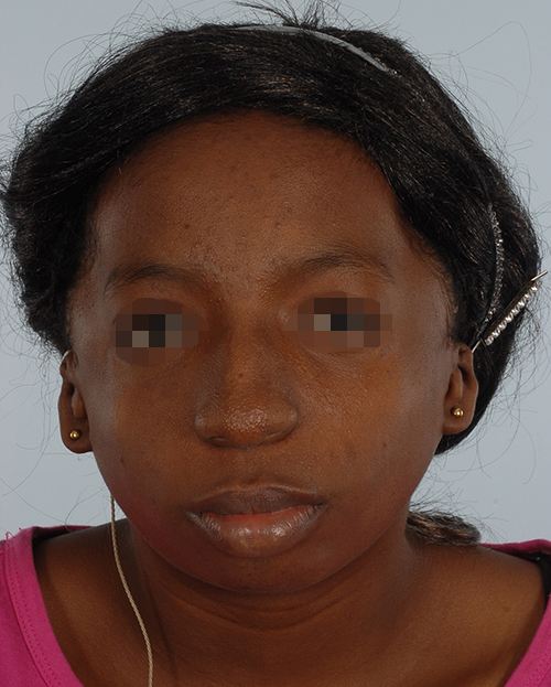 Craniofacial Cleft Case 3327 Before Photo Craniofacial Cleft