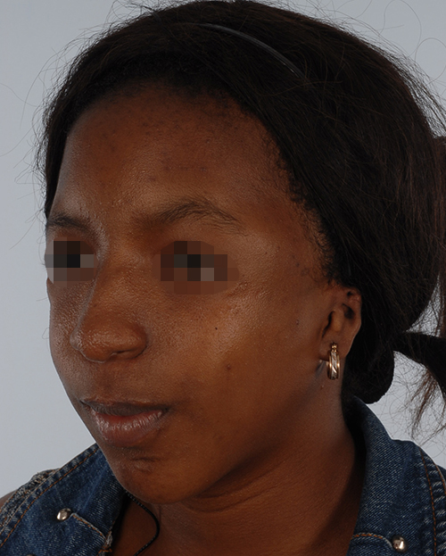 Craniofacial Cleft Case 3327 After Photo Craniofacial Cleft