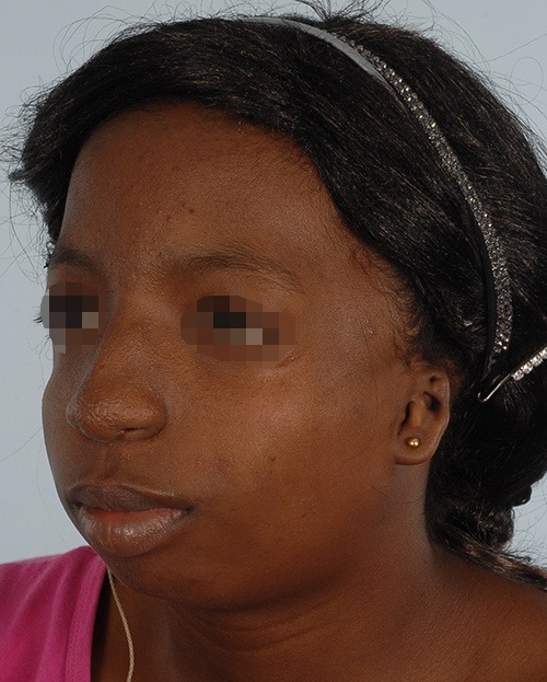 Craniofacial Cleft Case 3327 Before Photo Craniofacial Cleft