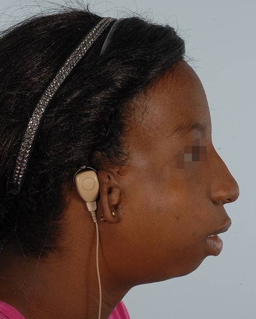 Craniofacial Cleft Case 3327 Before Photo Craniofacial Cleft