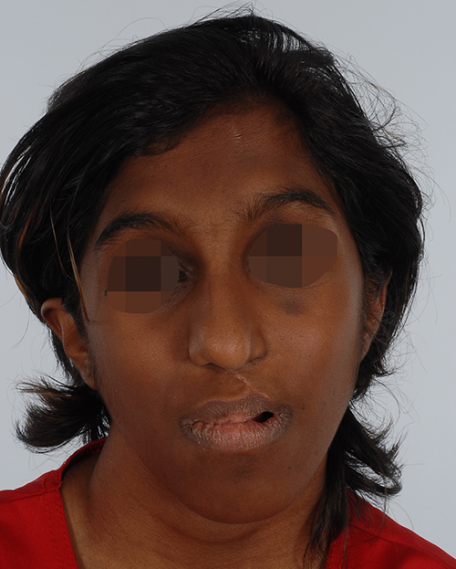 Craniofacial Cleft Case 3337 Before Photo Craniofacial Cleft