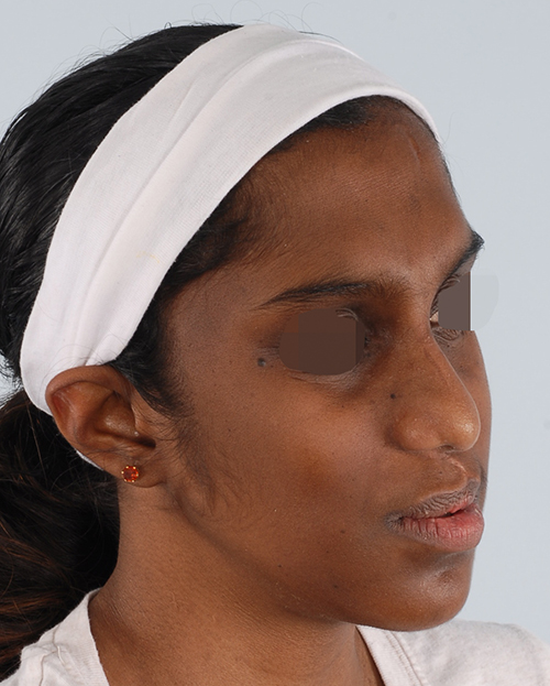 Craniofacial Cleft Case 3337 After Photo Craniofacial Cleft