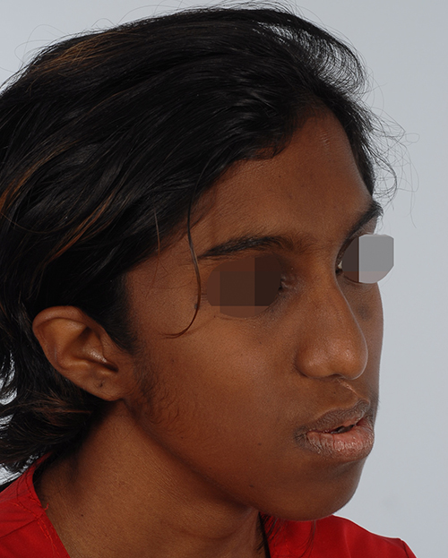 Craniofacial Cleft Case 3337 Before Photo Craniofacial Cleft