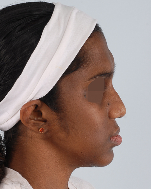Craniofacial Cleft Case 3337 After Photo Craniofacial Cleft