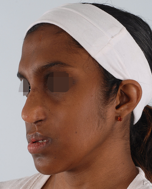 Craniofacial Cleft Case 3337 After Photo Craniofacial Cleft
