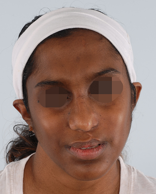 Craniofacial Cleft Case 3337 After Photo Craniofacial Cleft