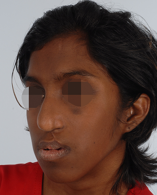 Craniofacial Cleft Case 3337 Before Photo Craniofacial Cleft
