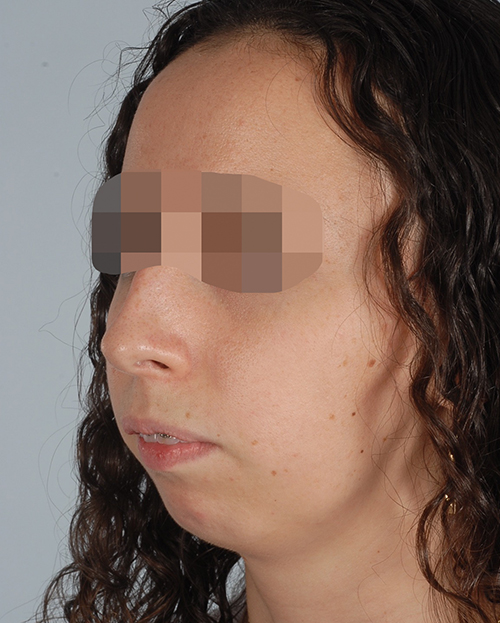Malocclusion Case 3347 Before Photo Malocclusion
