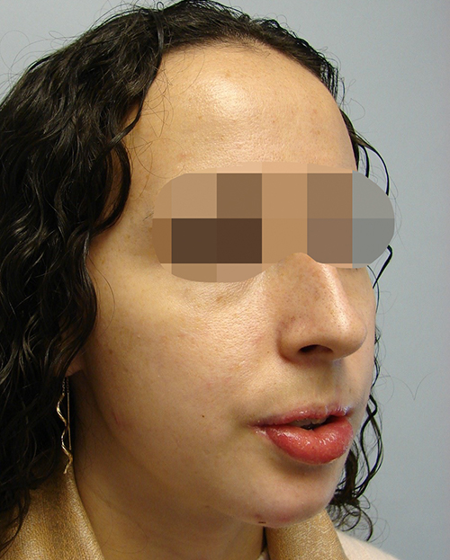 Malocclusion Case 3347 After Photo Malocclusion