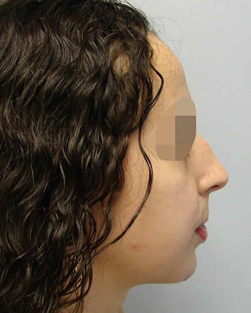 Malocclusion Case 3347 After Photo Malocclusion