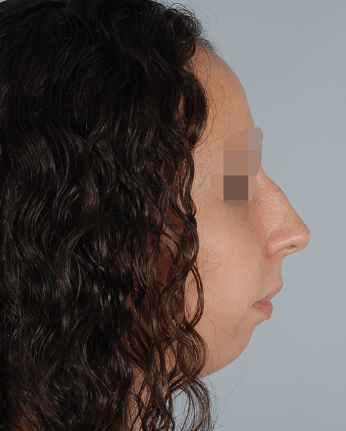 Malocclusion Case 3347 Before Photo Malocclusion