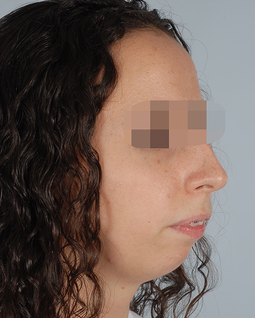 Malocclusion Case 3347 Before Photo Malocclusion