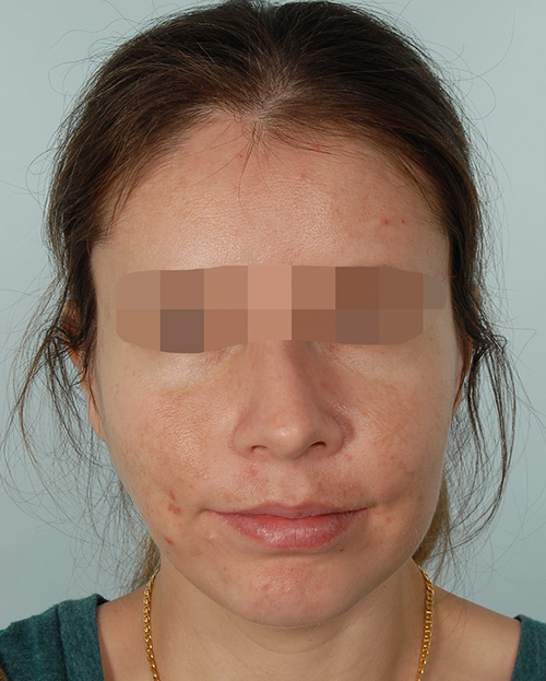Malocclusion Case 3348 After Photo Malocclusion