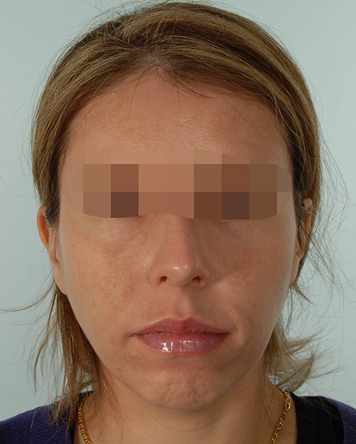 Malocclusion Case 3348 Before Photo Malocclusion