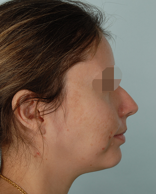 Malocclusion Case 3348 After Photo Malocclusion