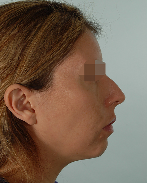 Malocclusion Case 3348 Before Photo Malocclusion