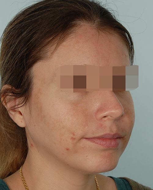 Malocclusion Case 3348 After Photo Malocclusion