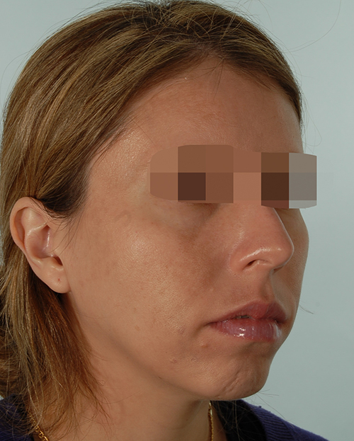 Malocclusion Case 3348 Before Photo Malocclusion