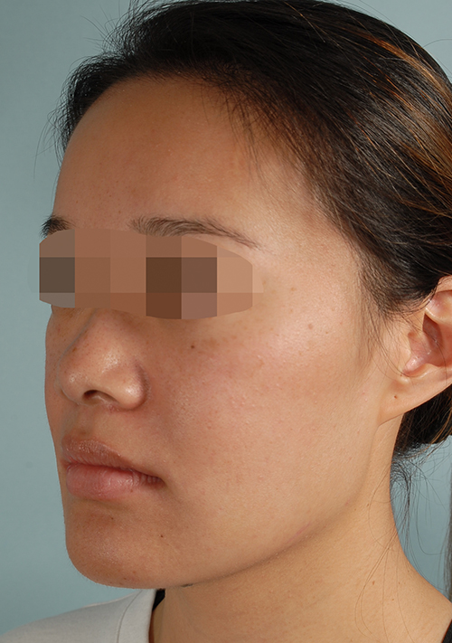 Malocclusion Case 3352 After Photo Malocclusion