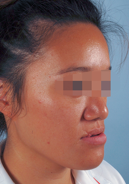 Malocclusion Case 3352 Before Photo Malocclusion