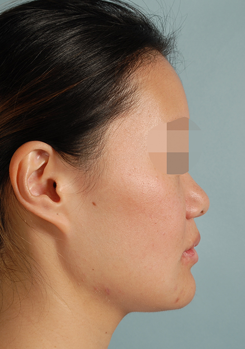 Malocclusion Case 3352 After Photo Malocclusion