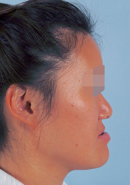 Malocclusion Case 3352 Before Photo Malocclusion
