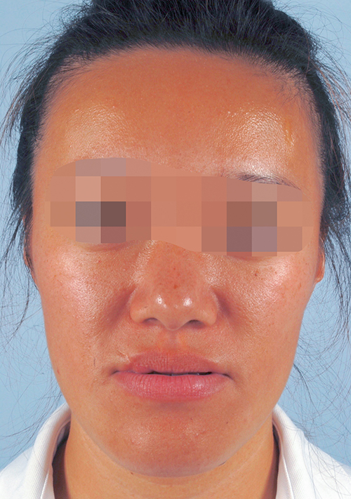 Malocclusion Case 3352 Before Photo Malocclusion