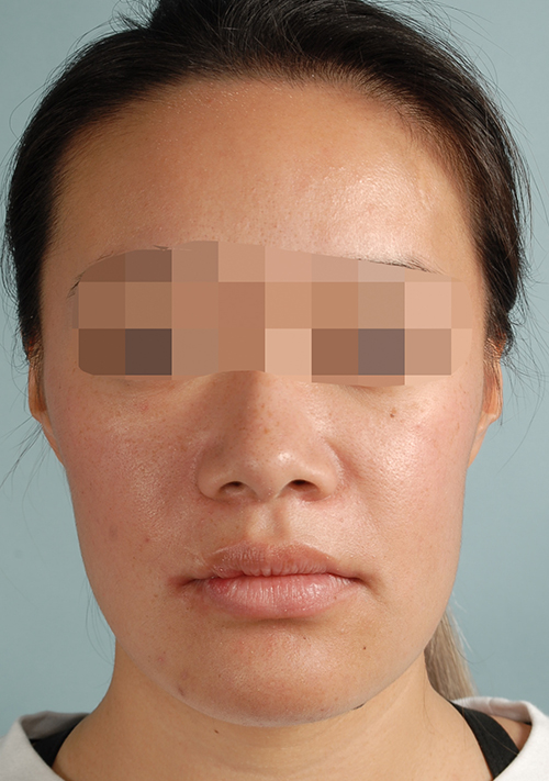 Malocclusion Case 3352 After Photo Malocclusion
