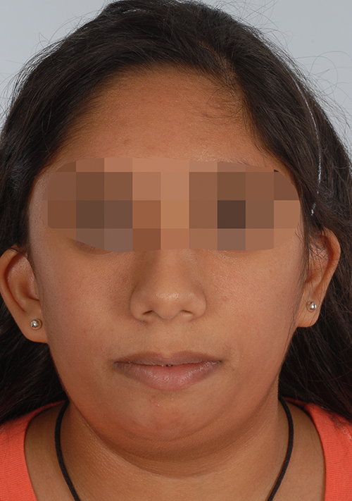 Malocclusion Case 3353 Before Photo Malocclusion