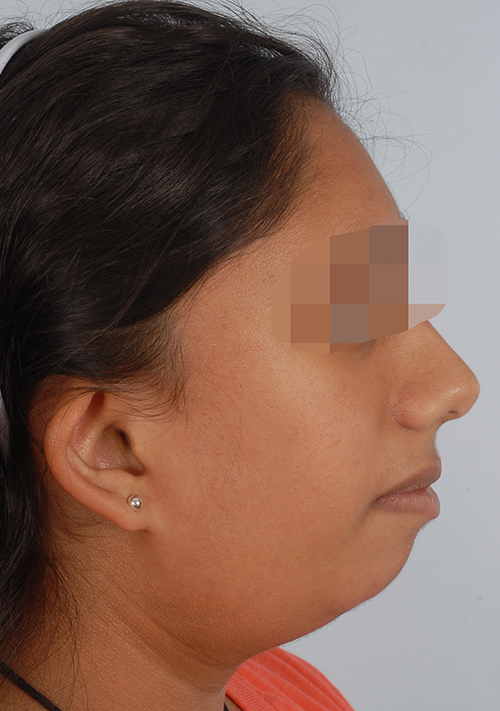 Malocclusion Case 3353 Before Photo Malocclusion