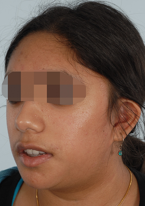Malocclusion Case 3353 After Photo Malocclusion