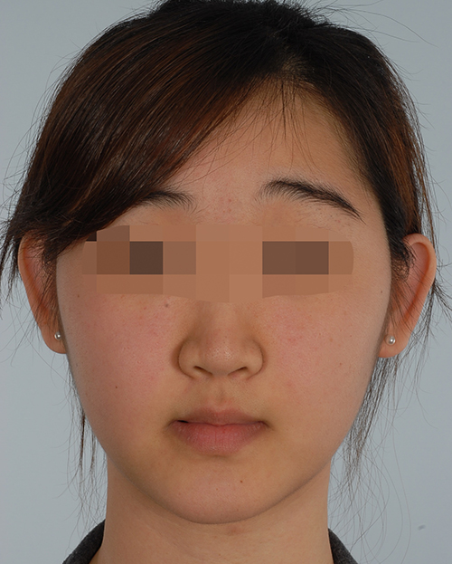 Malocclusion Case 3355 After Photo Malocclusion