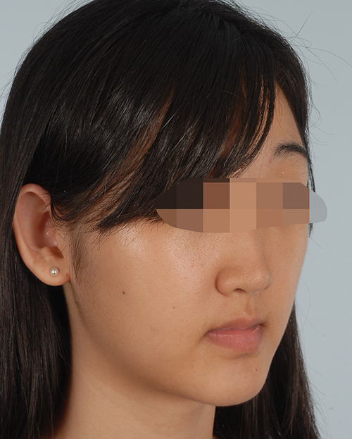 Malocclusion Case 3355 Before Photo Malocclusion