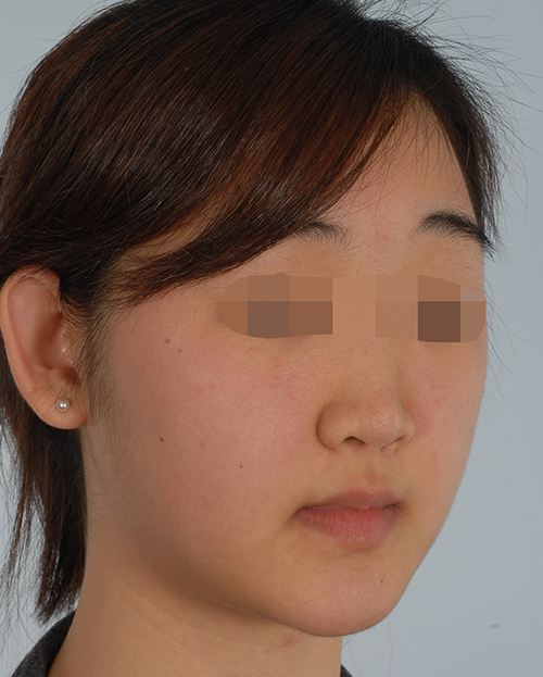 Malocclusion Case 3355 After Photo Malocclusion
