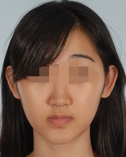 Malocclusion Case 3355 Before Photo Malocclusion